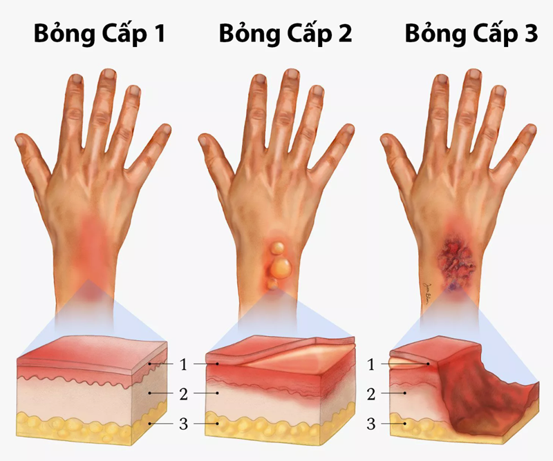 Phân biệt 3 cấp độ bỏng thường gặp để có hướng xử lý kịp thời và chính xác.
