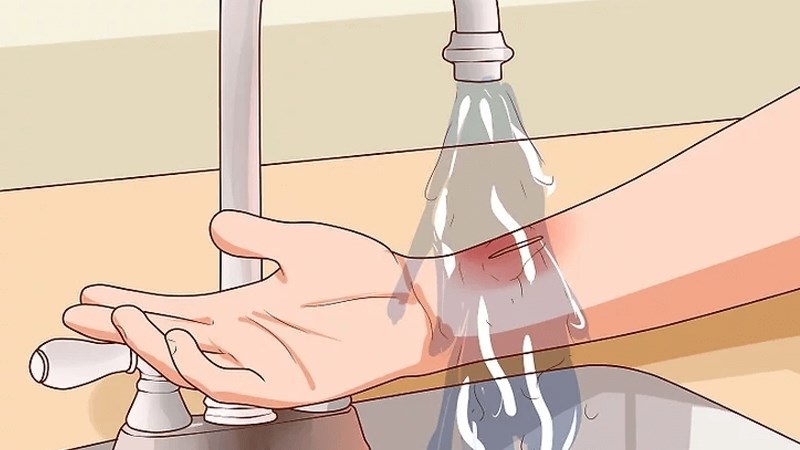 Xả nước mát lên vết bỏng trong 15-30 phút là "thời điểm vàng" để hạ nhiệt cho da.