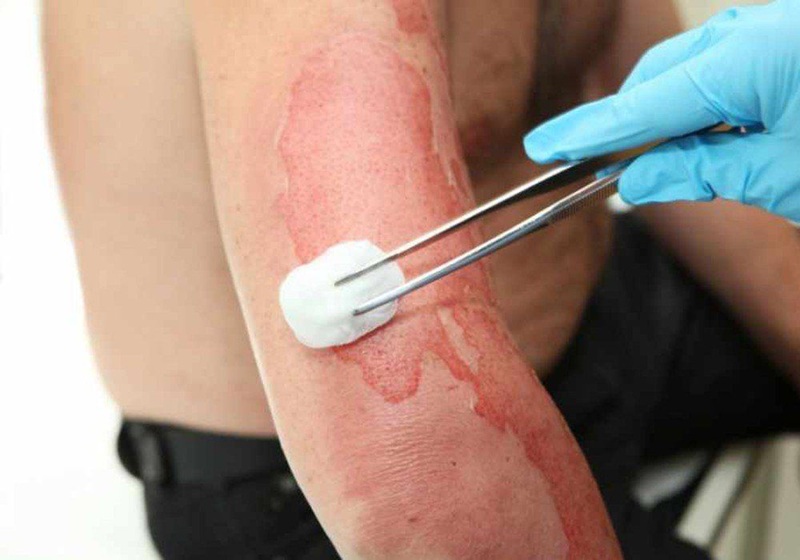 Những thực phẩm nên ăn và cần kiêng khem giúp vết bỏng mau lành, không để lại sẹo lồi.